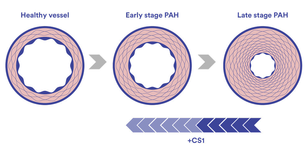 pathophysiology-of-pah